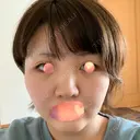 バッカルファット除去 湘南美容クリニック 新潟院 AFTER サムネイル用