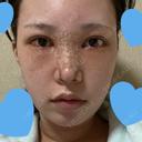 目頭切開 / 鼻尖形成（切開） / 額を丸く / 目尻切開 / 上まぶたの脂肪取り / 軟骨移植 / 脂肪注入（輪郭） TN整形外科 DAY 7 サムネイル用