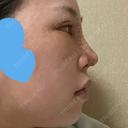 目頭切開 / 鼻尖形成（切開） / 額を丸く / 目尻切開 / 上まぶたの脂肪取り / 軟骨移植 / 脂肪注入（輪郭） TN整形外科 DAY 7 サムネイル用