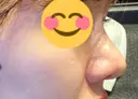 隆鼻術 / 鼻尖形成（切開） / 鼻中隔延長（切開） リエンジャン整形外科 江南店 DAY 39 サムネイル用