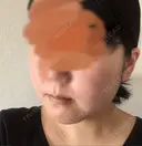 骨切り（あご） ボンディ美容整形外科（旧リオン整形外科） DAY 31 サムネイル用