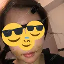 骨切り（あご） / 骨削り（エラ） / 脂肪注入（額） ボンディ美容整形外科（旧リオン整形外科） DAY 5 サムネイル用