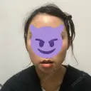 骨切り（あご） / 骨削り（エラ） ボンディ美容整形外科（旧リオン整形外科） DAY 7 サムネイル用