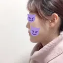 骨切り（あご） / 骨削り（エラ） ボンディ美容整形外科（旧リオン整形外科） DAY 11 サムネイル用