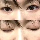 下まぶたたるみ取り セオリークリニック AFTER サムネイル用