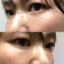 下まぶたたるみ取り セオリークリニック DAY 100 サムネイル用