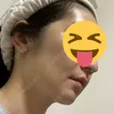 骨削り（頬） RG整形外科（旧リオン整形外科） DAY 11 サムネイル用