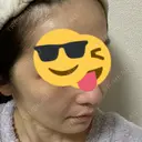 骨削り（頬） RG整形外科（旧リオン整形外科） DAY 11 サムネイル用