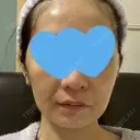 骨削り（頬） RG整形外科（旧リオン整形外科） DAY 9 サムネイル用