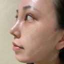 目頭切開 / 鼻尖形成（切開） / 額を丸く / 目尻切開 / 上まぶたの脂肪取り / 軟骨移植 / 脂肪注入（輪郭） TN整形外科 DAY 11 サムネイル用