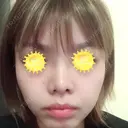 鼻尖形成（切開） / 小鼻縮小（切開） / 軟骨移植 / 眉間プロテーゼ 湘南美容クリニック 広島院 DAY 40 サムネイル用
