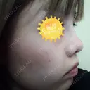鼻尖形成（切開） / 小鼻縮小（切開） / 軟骨移植 / 眉間プロテーゼ 湘南美容クリニック 広島院 DAY 40 サムネイル用