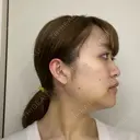 骨切り（あご） / 骨削り（エラ） ボンディ美容整形外科（旧リオン整形外科） DAY 7 サムネイル用