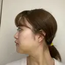 骨切り（あご） / 骨削り（エラ） ボンディ美容整形外科（旧リオン整形外科） DAY 7 サムネイル用