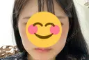 ボトックス（エラ・小顔） 品川スキンクリニック岡山院 DAY 34 サムネイル用