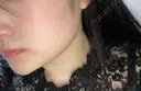ボトックス（エラ・小顔） 品川スキンクリニック岡山院 DAY 34 サムネイル用