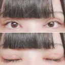 二重切開 / 目頭切開 / 上まぶたたるみ取り 湘南美容クリニック 金沢院 DAY 6 サムネイル用