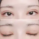 二重切開 / 目頭切開 / 上まぶたたるみ取り 湘南美容クリニック 金沢院 DAY 8 サムネイル用