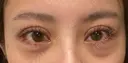 二重切開 / 眼瞼下垂（切開） / 目尻切開 / 上まぶたの脂肪取り / タレ目形成・グラマラスライン（切開） id（アイディ）美容外科 DAY 17 サムネイル用