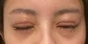 二重切開 / 眼瞼下垂（切開） / 目尻切開 / 上まぶたの脂肪取り / タレ目形成・グラマラスライン（切開） id（アイディ）美容外科 DAY 17 サムネイル用