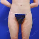 脂肪吸引（脚） / 脂肪吸引（お腹） / 豊胸（脂肪注入） 新宿美容外科クリニック 立川院 DAY 29 サムネイル用