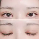 二重切開 / 目頭切開 / 上まぶたたるみ取り 湘南美容クリニック 金沢院 DAY 9 サムネイル用