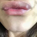 ボトックス（あご） TCB東京中央美容外科 京都駅前院 AFTER サムネイル用