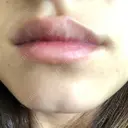 ボトックス（あご） TCB東京中央美容外科 京都駅前院 DAY 18 サムネイル用