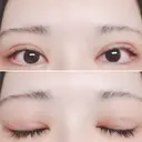 二重切開 / 目頭切開 / 上まぶたたるみ取り 湘南美容クリニック 金沢院 DAY 10 サムネイル用