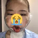 骨切り（あご） / 骨削り（エラ） ボンディ美容整形外科（旧リオン整形外科） DAY 0 サムネイル用