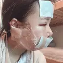 骨切り（あご） / 骨削り（エラ） ボンディ美容整形外科（旧リオン整形外科） DAY 2 サムネイル用