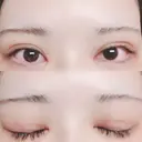 二重切開 / 目頭切開 / 上まぶたたるみ取り 湘南美容クリニック 金沢院 DAY 13 サムネイル用