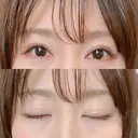 二重切開 / 眼瞼下垂（切開） / 上まぶたたるみ取り 湘南美容クリニック 新宿南口院 AFTER サムネイル用