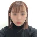 バッカルファット除去 / ボトックス（エラ・小顔） 湘南美容クリニック 秋葉原院 DAY 48 サムネイル用