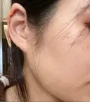 ボトックス（エラ・小顔） 品川スキンクリニック岡山院 DAY 40 サムネイル用