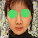 骨切り（あご） / 骨削り（エラ） / 骨削り（頬） / ルフォー+ssro（両あご) id（アイディ）美容外科 AFTER サムネイル用