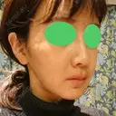 骨切り（あご） / 骨削り（エラ） / 骨削り（頬） / ルフォー+ssro（両あご) id（アイディ）美容外科 DAY 142 サムネイル用