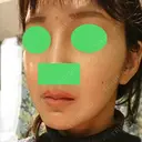 骨切り（あご） / 骨削り（エラ） / 骨削り（頬） / ルフォー+ssro（両あご) id（アイディ）美容外科 DAY 142 サムネイル用