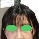 骨切り（あご） / 骨削り（エラ） / 骨削り（頬） / ルフォー+ssro（両あご) id（アイディ）美容外科 DAY 15 サムネイル用