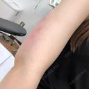 脂肪吸引（二の腕） 湘南メディカル記念病院（両国） DAY 39 サムネイル用