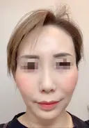 その他（目元） / クマ治療 / 額を丸く / その他（輪郭） / 下まぶたの脂肪取り / 脂肪注入（肌） / こめかみ形成 / 脂肪注入（額） / ヒアルロン酸注入（涙袋） / 脂肪注入（輪郭） / PRP皮膚再生療法 ジュエリー美容外科 AFTER サムネイル用