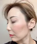 その他（目元） / クマ治療 / 額を丸く / その他（輪郭） / 下まぶたの脂肪取り / 脂肪注入（肌） / こめかみ形成 / 脂肪注入（額） / ヒアルロン酸注入（涙袋） / 脂肪注入（輪郭） / PRP皮膚再生療法 ジュエリー美容外科 DAY 60 サムネイル用