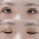 二重埋没 / 上まぶたの脂肪取り 湘南美容クリニック 京都院 DAY 5 サムネイル用