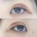 二重埋没 / 上まぶたの脂肪取り 湘南美容クリニック 京都院 DAY 5 サムネイル用