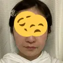 骨削り（頬） RG整形外科（旧リオン整形外科） DAY 21 サムネイル用