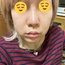 隆鼻術 品川美容外科 名古屋院 DAY 4 サムネイル用