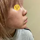 隆鼻術 品川美容外科 名古屋院 DAY 5 サムネイル用