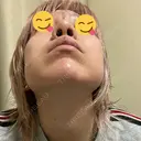 隆鼻術 品川美容外科 名古屋院 DAY 5 サムネイル用