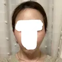 バッカルファット除去 / 脂肪吸引（顔） / ボトックス（あご） / 水光注射（ハリ・美肌） / ヒアルロン酸注入（あご） / ボトックス（エラ・小顔） / 脂肪溶解注射（顔） / ヒアルロン酸注入（唇） エートップ美容整形外科 AFTER サムネイル用