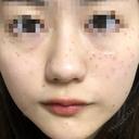 ピコレーザートーニング（美白・肝斑） UB CLINIC 銀座 DAY 0 サムネイル用